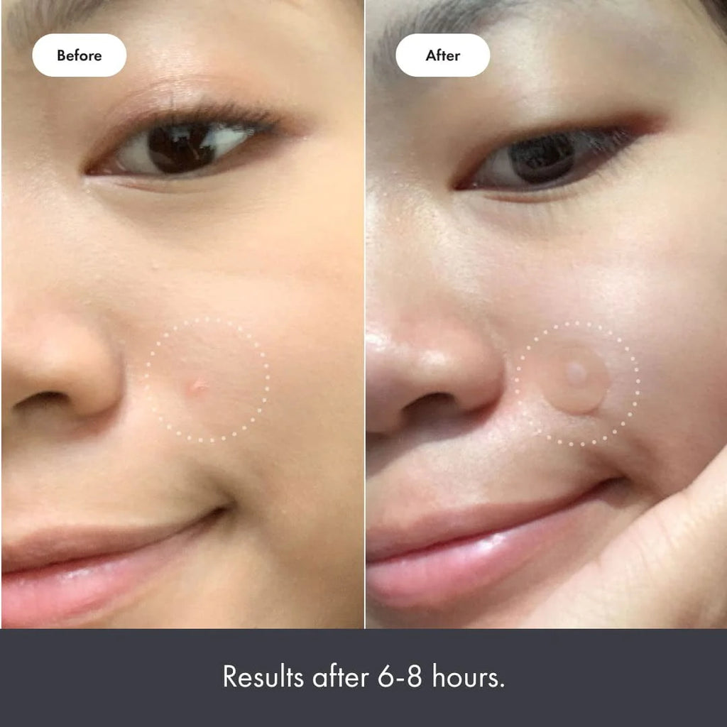 Hydrocolloid Acne Pimple Patch (27 Patches) W4544