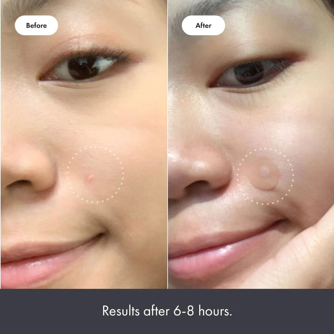 Hydrocolloid Acne Pimple Patch (27 Patches) W4544